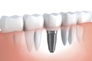 Implantes-dentarios.webp